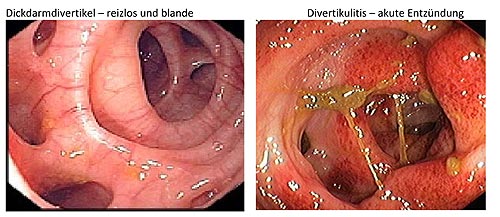 Divertikulose1